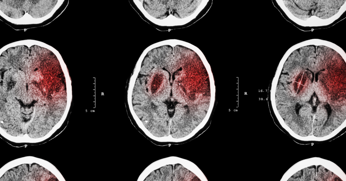 vascular dementia stroke scan