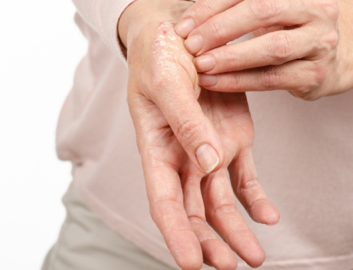 Senior Help: What You Need to Know About Psoriasis